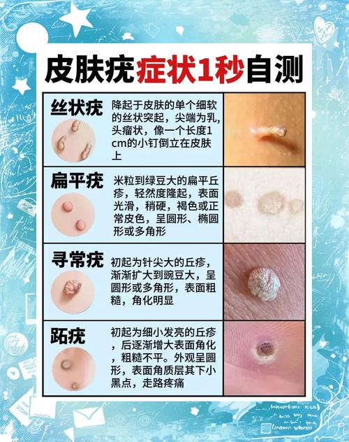 免疫力提升(免疫力提升的话疣会消失吗)